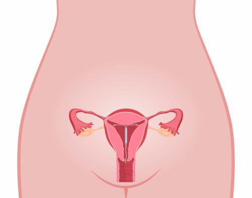 Intrauterine Devices diagram.
