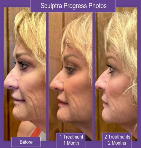 Sculptra before and after photos.
